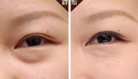沈陽(yáng)哪家醫(yī)院做脂肪隆胸效果好且價(jià)格合理？