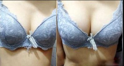 廣州哪家醫(yī)院的乳頭凹陷術(shù)效果好？