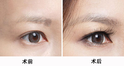 韓國(guó)醫(yī)生張柱允的顴骨磨骨技術(shù)整容潮流。