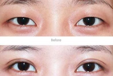 杭州開(kāi)眼角醫(yī)生哪家好？專家推薦的杭州開(kāi)眼角醫(yī)院排行榜