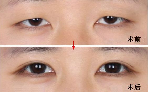 南京哪家醫(yī)院去眼袋好？眼袋手術(shù)選哪家醫(yī)院最好