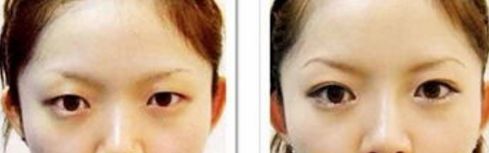 深圳眼袋手術哪家醫(yī)院最靠譜？