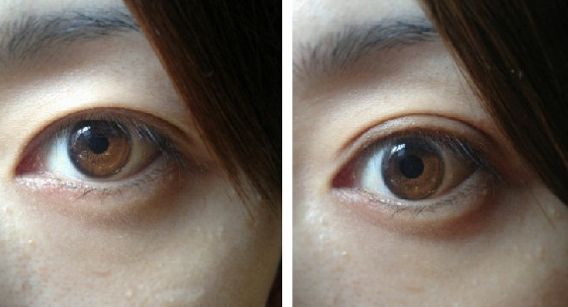 北京開(kāi)眼角好的醫(yī)院有哪些？
