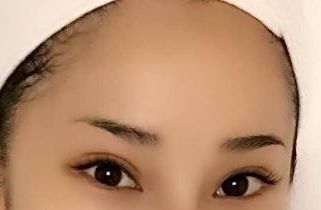 上海醫(yī)院最好治療皮膚疤痕的?？剖悄募遥?>上海醫(yī)院最好治療皮膚疤痕的?？剖悄募?？</a></h4>
                                    <p>上海是中國的大都市，也是醫(yī)療美容行業(yè)發(fā)展最為成熟的城市之一。在上海，有許多醫(yī)療機(jī)構(gòu)提供專業(yè)的皮膚疤痕治療服務(wù)。下面將介紹幾家在上海治療皮膚疤痕方面表現(xiàn)較好的?？漆t(yī)院。上海華美醫(yī)療美容醫(yī)院上海華美醫(yī)療美容醫(yī)院是一家全國性連鎖醫(yī)療美容機(jī)構(gòu)，擁有規(guī)模較大的整形外科醫(yī)生隊(duì)伍。每位醫(yī)生都有自己的擅長項(xiàng)目，并取                                    </p>
                            </div>
                        </div>
                    </li>
	
                </ul>
            </div>
        </div>
        <div   id=