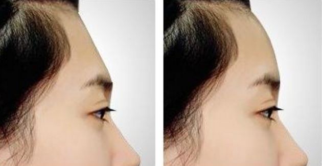 南京割雙眼皮哪家醫(yī)院效果好？