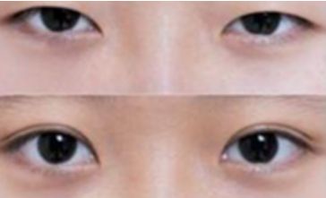 秦皇島雙眼皮哪家做的好？選擇前必看！