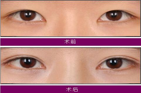 大連注射玻尿酸哪家醫(yī)院技術(shù)好，效果持久？