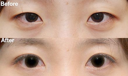 2023深圳黃金微針去除口周紋醫(yī)生綜合實力排行榜(鄭瑜璠、吳曉玲、劉彤大勢醫(yī)美重磅來襲)