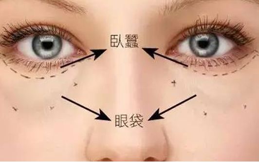 ?？谀募裔t(yī)院做眼袋效果好？