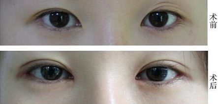 福州抽脂大腿哪家醫(yī)院好？挑選福州最靠譜的抽脂醫(yī)院有哪些？