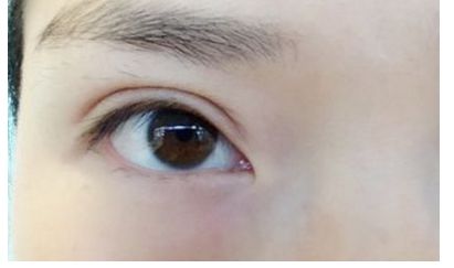 南昌祛痘哪家醫(yī)院口碑好，效果最佳？