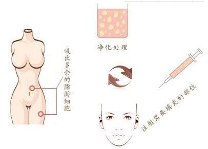 廣州燒傷疤痕治療哪家醫(yī)院效果好，選擇哪家醫(yī)院最靠譜？