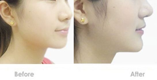 蘇州嘴唇改薄哪家醫(yī)院好？專業(yè)的整形醫(yī)院推薦