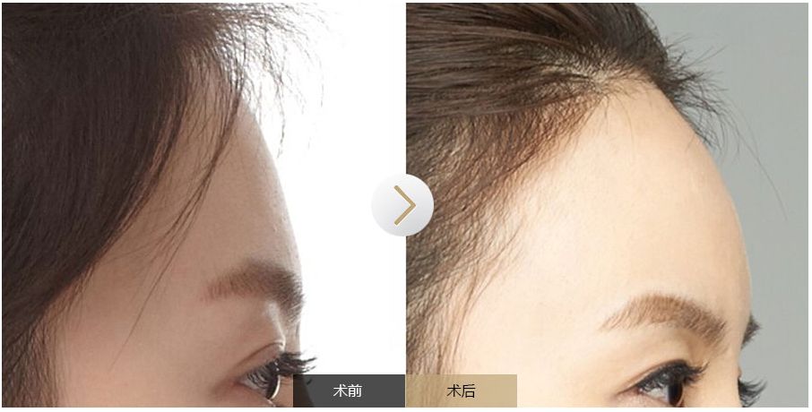 南寧點(diǎn)痣需求旺盛，哪家醫(yī)院是最受歡迎的？