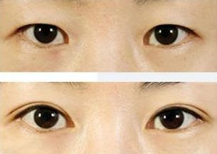 上海治療青春痘的專家推薦，哪家醫(yī)院效果最佳？