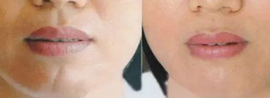 上海面部除疤效果最好的醫(yī)院有哪些？