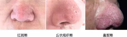 解密楊杰雙眼皮修復失敗案例圖，讓你心中的期望成為現(xiàn)實！