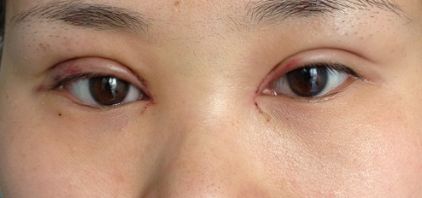 沈陽(yáng)哪家醫(yī)院疤痕手術(shù)效果好？