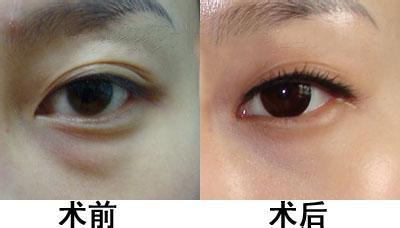 上海天壇普華醫(yī)院優(yōu)秀拉皮專家解析，手術(shù)費用清單附中