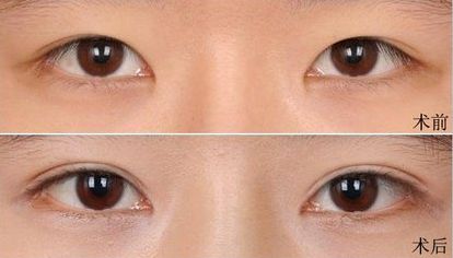 大連假體隆鼻哪家醫(yī)院好？打造完美鼻型，這家醫(yī)院是最佳選擇！