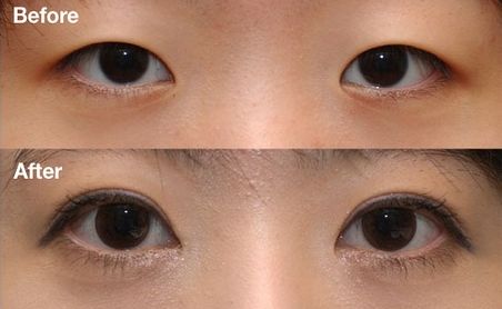 杭州雙眼皮醫(yī)院排名Top1，哪家醫(yī)院做雙眼皮效果好？