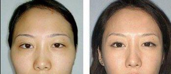 重慶去眼袋哪家醫(yī)院好？選擇靠譜的醫(yī)療機構，功效更可靠！