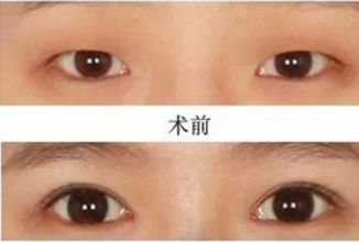 昆明哪家醫(yī)院做熱瑪吉好？挑選昆明熱瑪吉治療專(zhuān)業(yè)的醫(yī)院指南