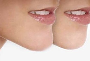 河南唇腭裂休復哪家好？專業(yè)醫(yī)院推薦及成功案例分享