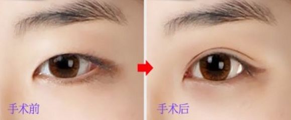 上海玻尿酸豐唇哪家醫(yī)院好？挑選上?？诒玫牟Ｄ蛩嶝S唇醫(yī)院
