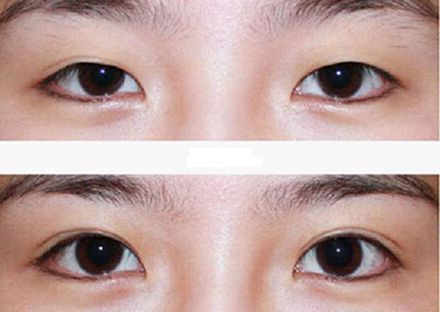 【2023年蘭州歪脖子手術(shù)哪家好？專家推薦+真實案例分析】