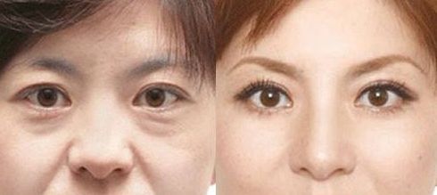 成都做乳暈漂紅哪家好？乳暈漂紅的價(jià)格、效果、方法哪種最合適？