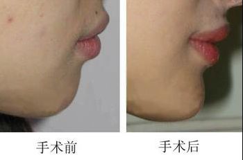 昆明哪家醫(yī)院做上臉下垂手術(shù)好，醫(yī)生技術(shù)靠譜？
