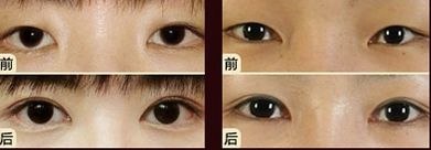 嘟嘟唇無(wú)錫哪家醫(yī)院好？專(zhuān)家推薦無(wú)錫哪家醫(yī)院治療嘟嘟唇好