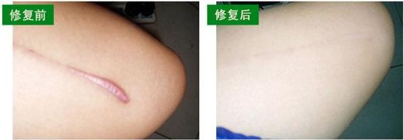 上海微創(chuàng)除皺哪家醫(yī)院好？了解上海微創(chuàng)除皺治療的專(zhuān)業(yè)醫(yī)院推薦