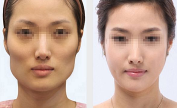 長春雙眼皮修復(fù)好的醫(yī)院有哪些？