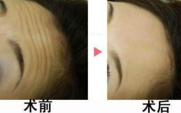 揭秘北京隆鼻領(lǐng)域的專家陳育哲、連凱峰等五位口碑扎實的權(quán)威專家