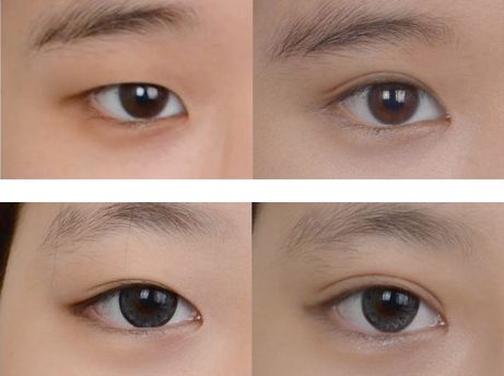 修復(fù)過寬雙眼皮手術(shù)，寬度調(diào)整方案推薦