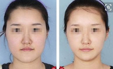美容拉皮手術(shù)費用受這3個因素影響，術(shù)前必看攻略大揭秘