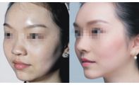 隆鼻失敗修復(fù)的價(jià)格受哪些因素影響