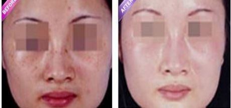 激光縮陰是否會(huì)導(dǎo)致副作用？找到安全有效的解決方法