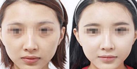 容城洗牙價格一覽，潔牙需花多少錢？