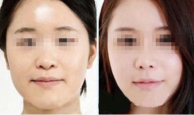 激光去除眼袋，持久效果有多久？價格如何，眼周抗衰秘笈大揭示
