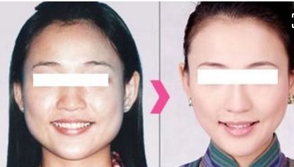 注射隆鼻會對身體健康產(chǎn)生什么影響