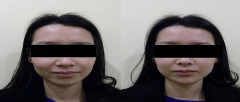 上瞼下垂手術(shù)的關(guān)鍵要素及事前事后的注意事項