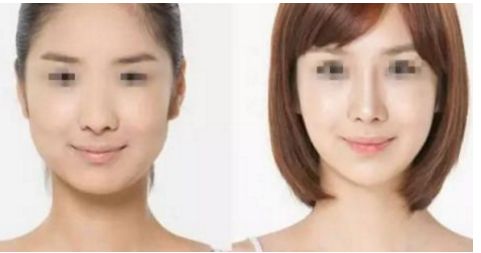 威寧隆胸手術(shù)效果如何？術(shù)后持久無需擔心！