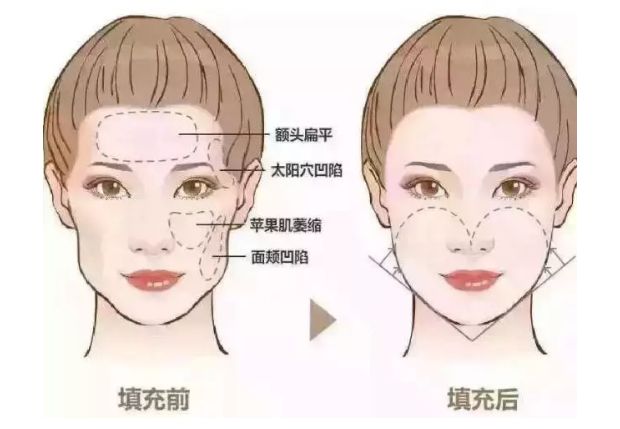 果酸療程：花多少錢一次？肌膚煥變?nèi)ヂ裕?xì)節(jié)也不能忽視！