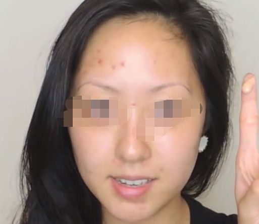 延長(zhǎng)透明質(zhì)酸隆鼻效果，多種小竅門(mén)讓您保持完美鼻形