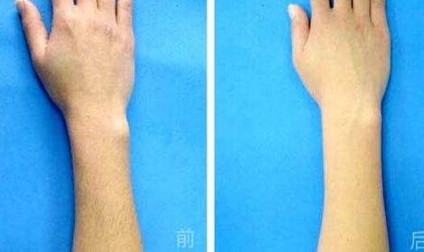 腹部吸脂手術(shù)是否存在副作用？