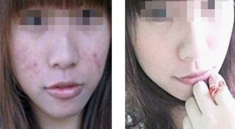 危害程度如何？全方位解析臉部拉皮手術(shù)風險與安全