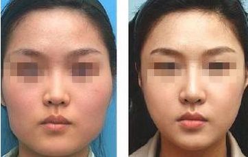 如何改善圓臉型，輕松塑造瓜子臉？五個有效技巧揭秘！